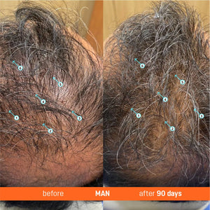 Abera Redensyl Hair Growth Serum Drug-Free Hair Thickening Serum - Abera
