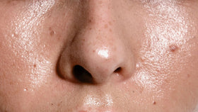 Acne & Oily Skin