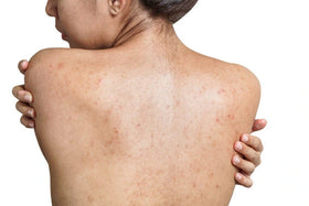 Body Bumps & Folliculitis