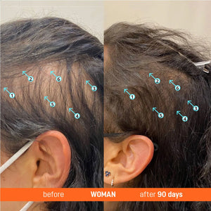 Abera Redensyl Hair Growth Serum Drug-Free Hair Thickening Serum - Abera