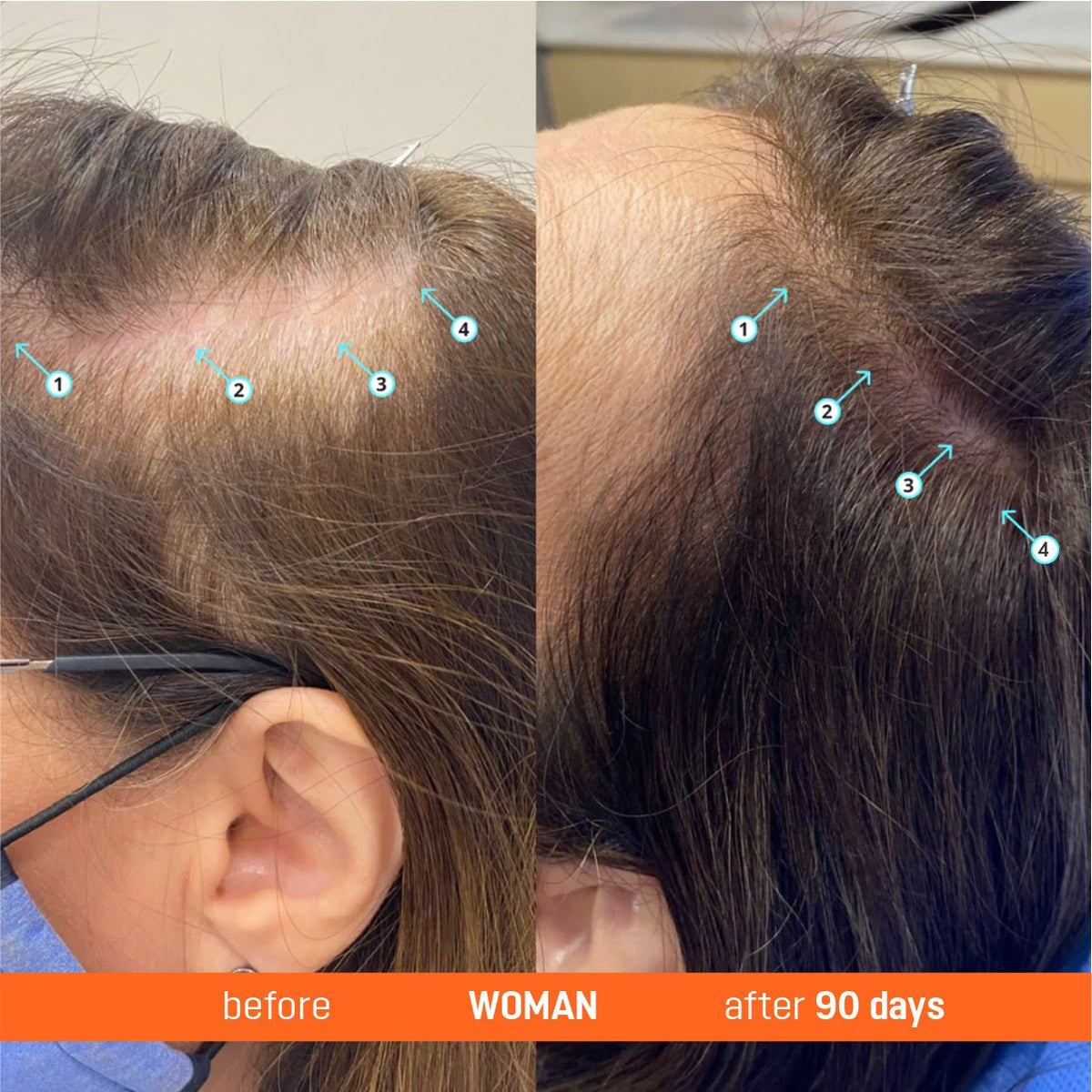 Abera Redensyl Hair Growth Serum Drug-Free Hair Thickening Serum - Abera
