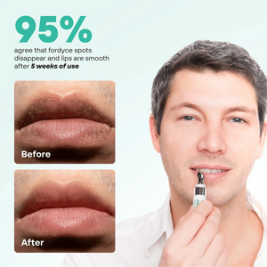 Before and after photos of lips next to a man applying ABERA Fordyce Cream, with a 5-week user survey result