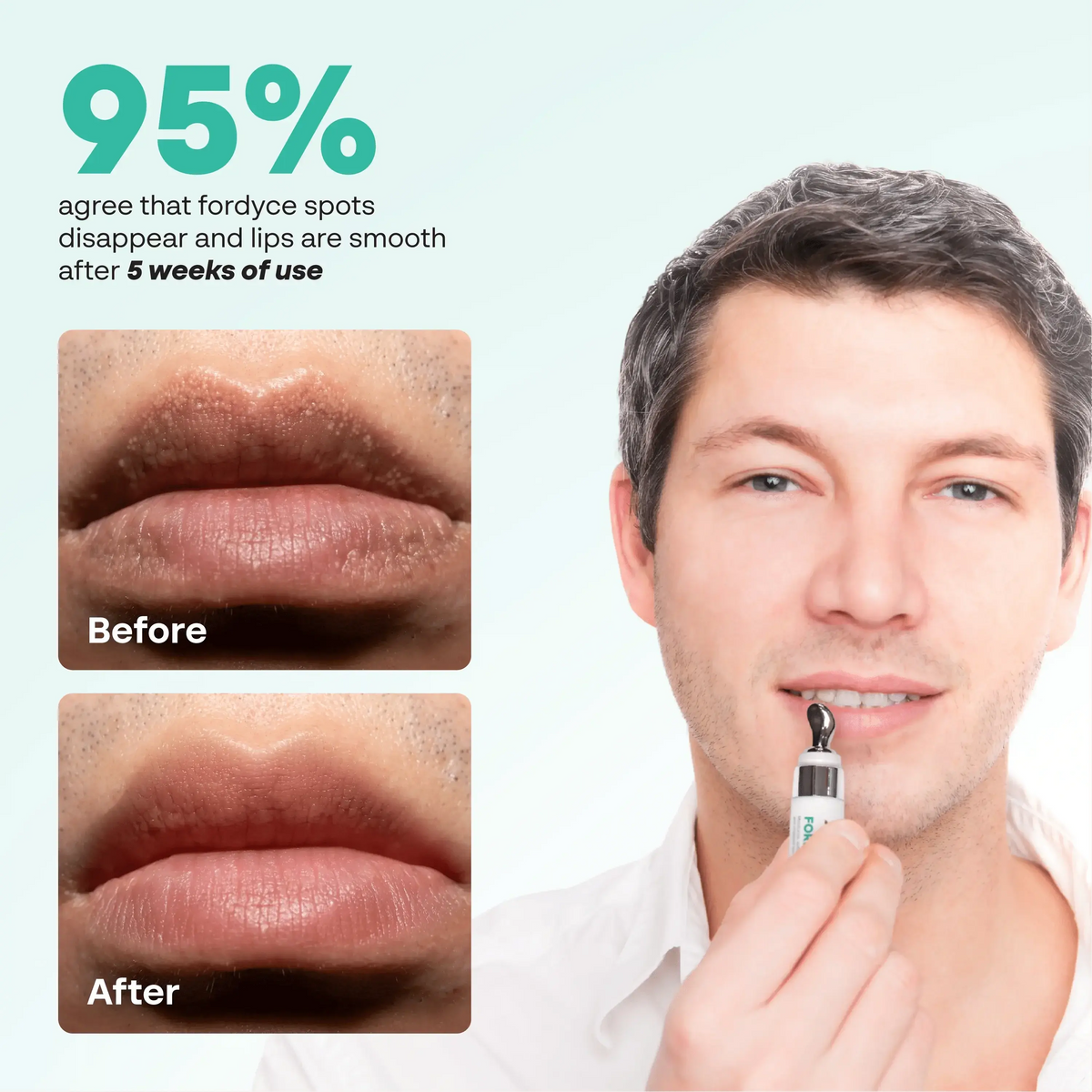 Before and after photos of lips next to a man applying ABERA Fordyce Cream, with a 5-week user survey result